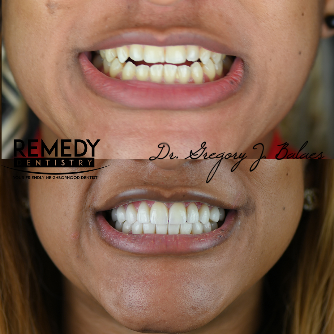 BEFAFT-VENEERS