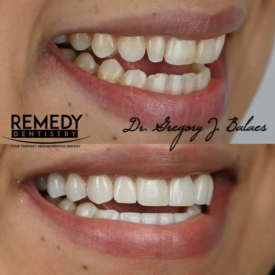 veneers-staten-island-3