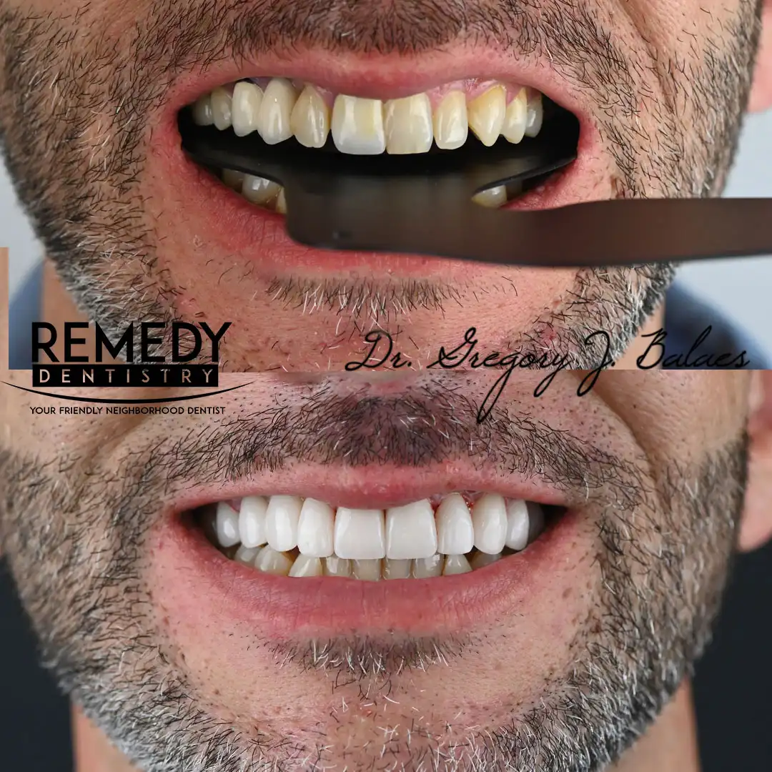 veneers-staten-island