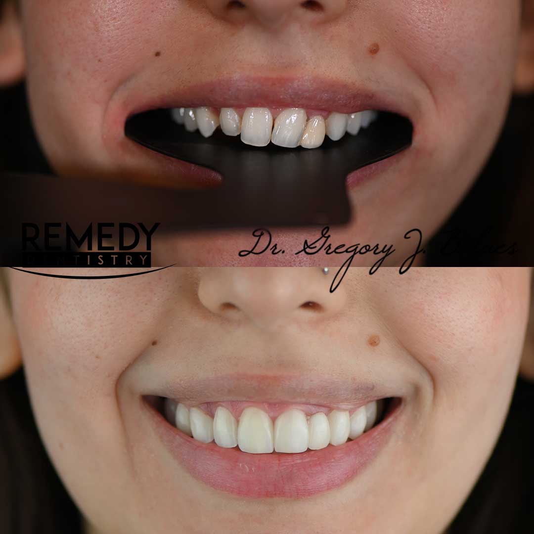 Before and after porcelain veneers smile makeover at Remedy Dentistry in Staten Island